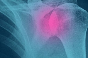 Illustration of a human skeleton with the shoulder joint highlighted in pink